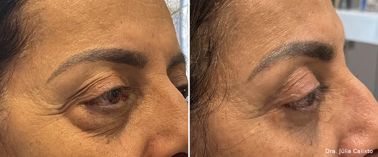 Paciente antes e após remoção de bolsas de gordura, vista lateral