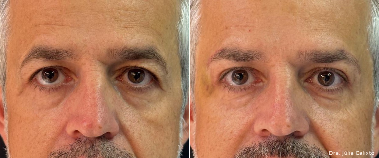 Paciente masculino antes e após blefaroplastia superior e lifting de supercílios