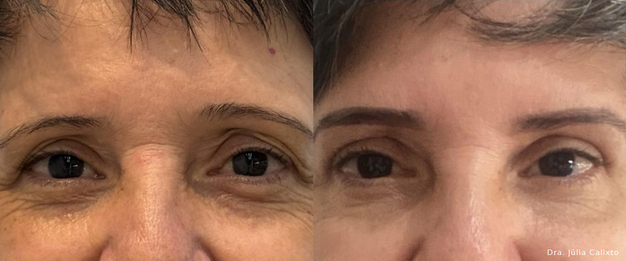 Paciente antes e após blefaroplastia superior e lifting de supercílios, vista frontal